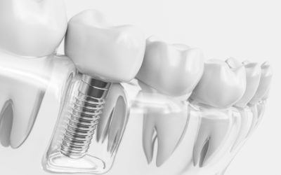 Comment bien préparer et gérer la période post-opératoire en implantologie dentaire