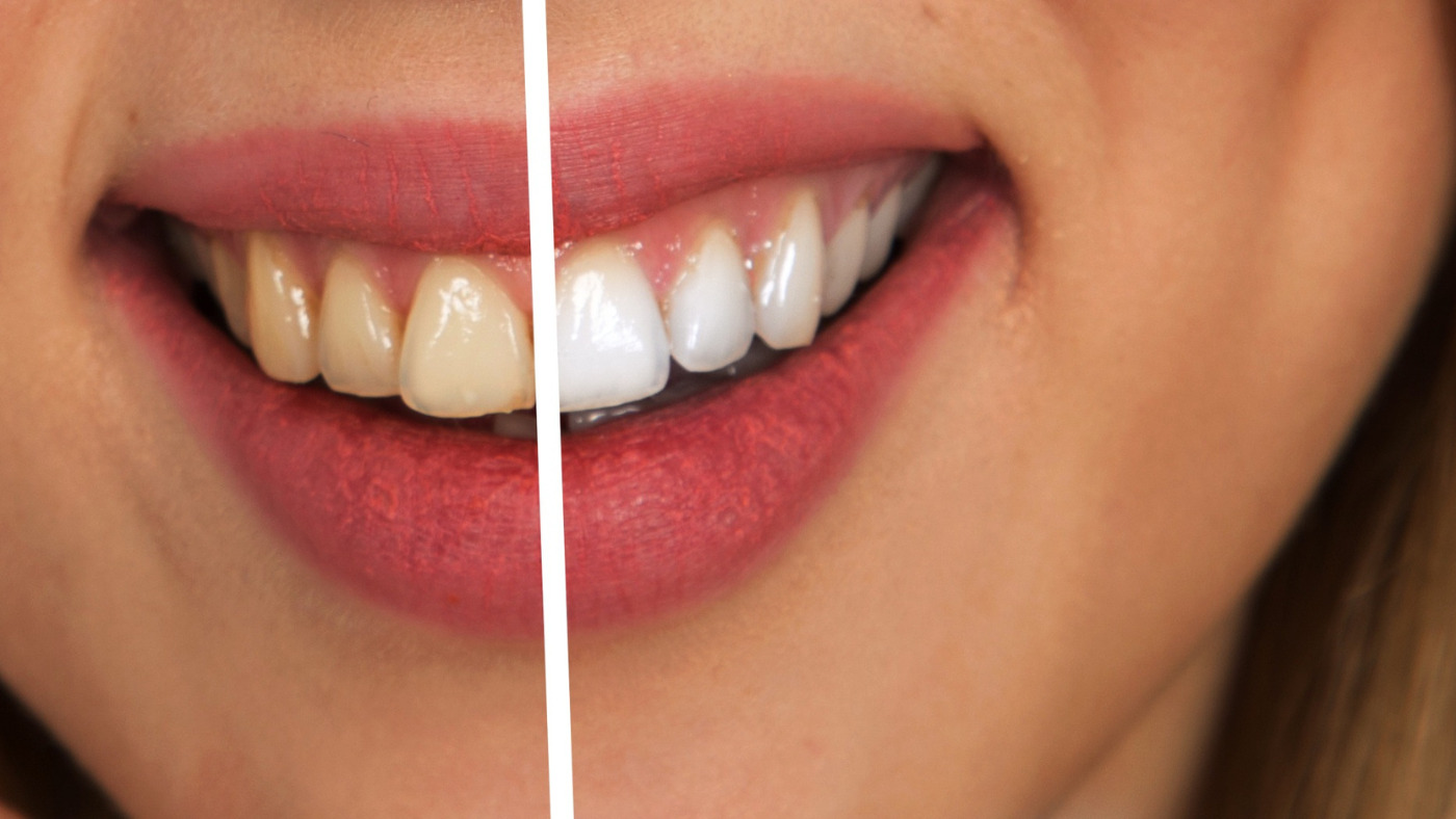 dent blanche avant et après traitement