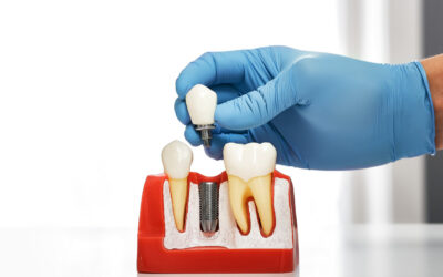 Comprendre l’implantologie dentaire 