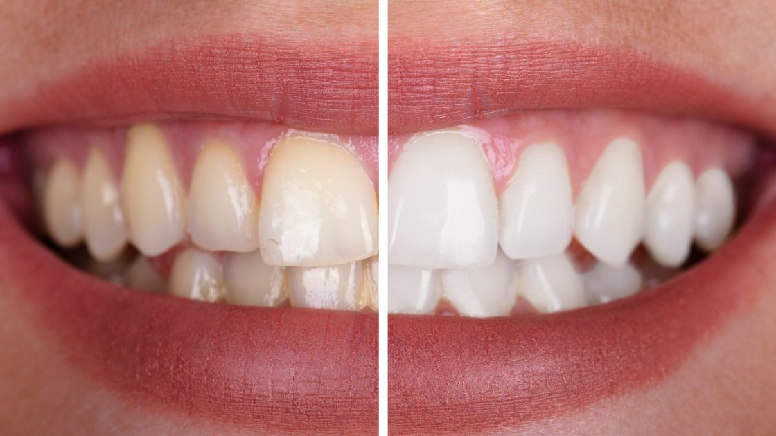 comparaison blanchiment des dents avant et après